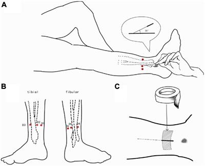 Frequency-Specific Blood Oxygen Level Dependent Oscillations Associated With Pain Relief From Ankle Acupuncture in Patients With Chronic Low Back Pain